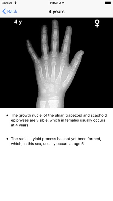 greulich and pyle bone age atlas